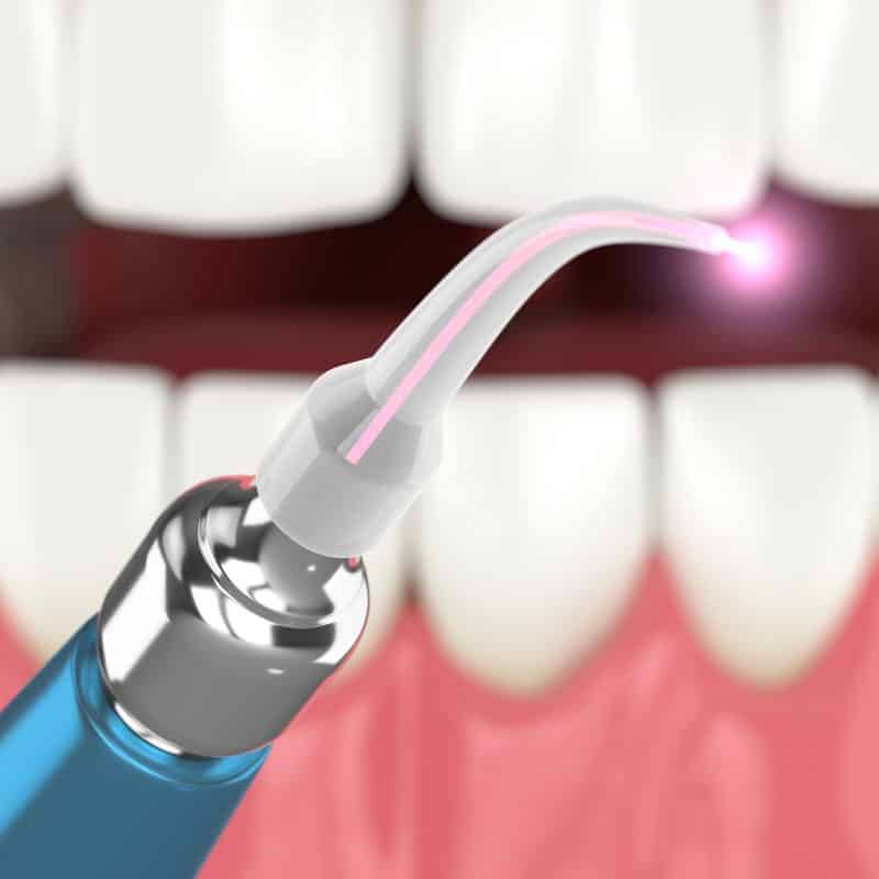 laser periodontal treatment graphic